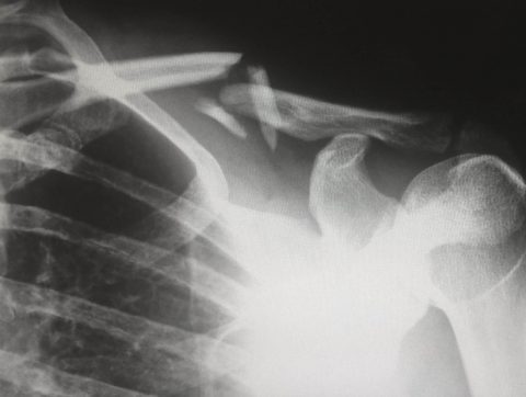 Mieux détecter les fractures sur des radiographies grâce à l’IA