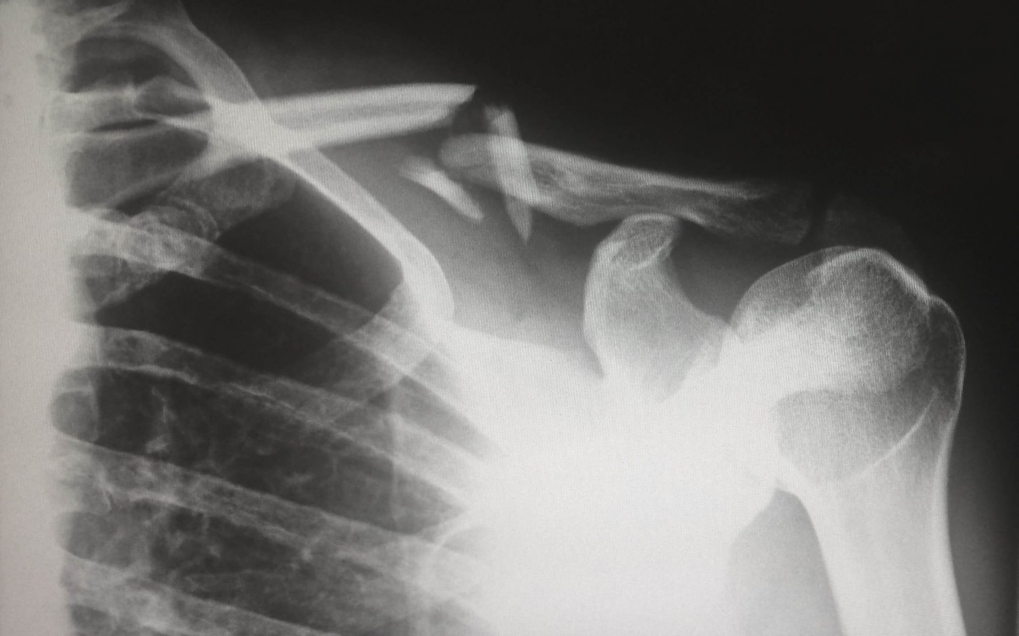 Mieux détecter les fractures sur des radiographies grâce à l’IA