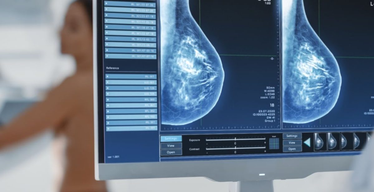 Un nouvel outil québécois en IA pour optimiser la détection des cancers du sein